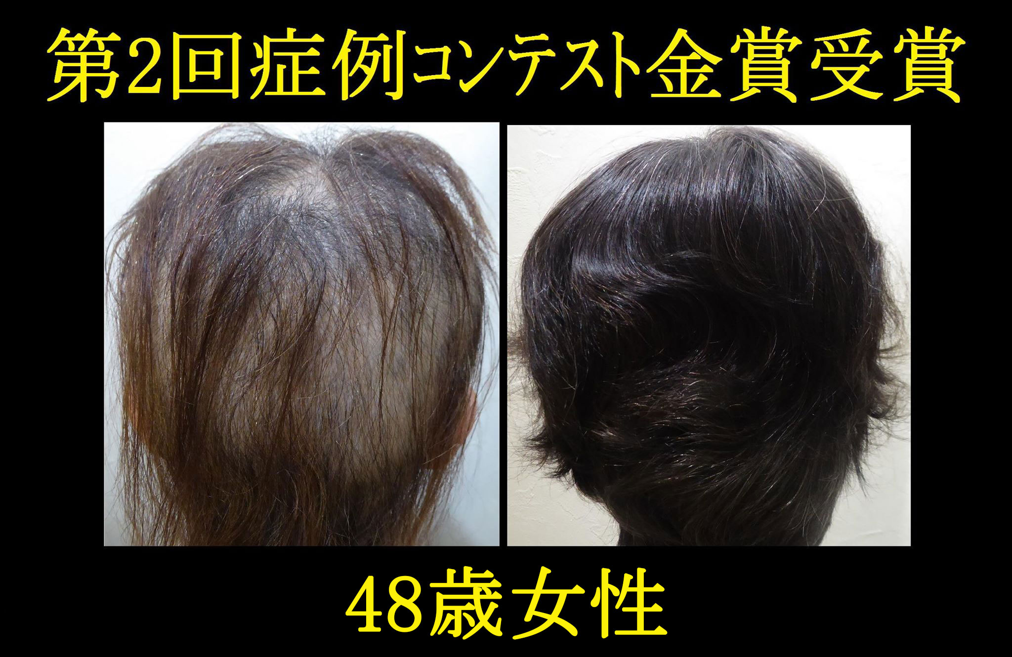 発毛症例1