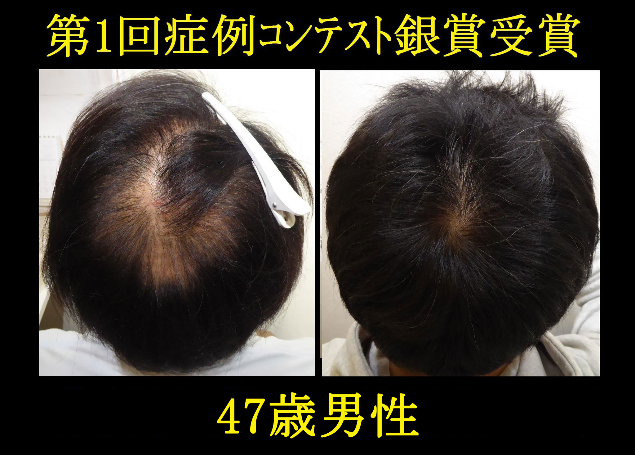 発毛症例2