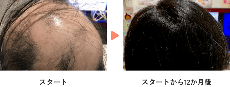 56歳・女性発毛効果