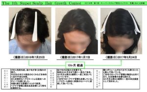 若ハゲに悩む学生が急増中 10代に起こる薄毛の原因と対策方法 スーパースカルプ発毛センター