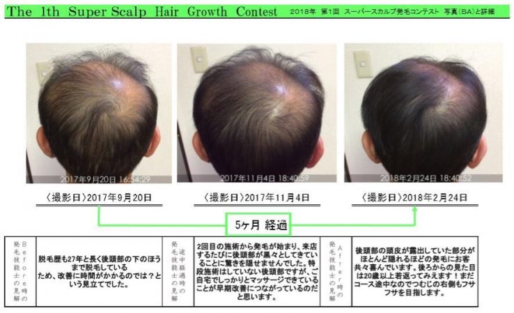 リーブ21 スカルプ 薄毛 抜け毛 脱毛 ハゲのケア | gkcsu.org