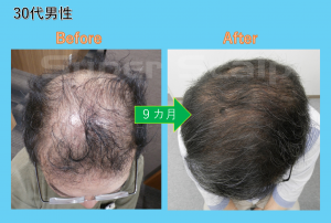 40代男性発毛実績 反抗期の子供たちに ハゲ と言われ スーパースカルプ発毛センター