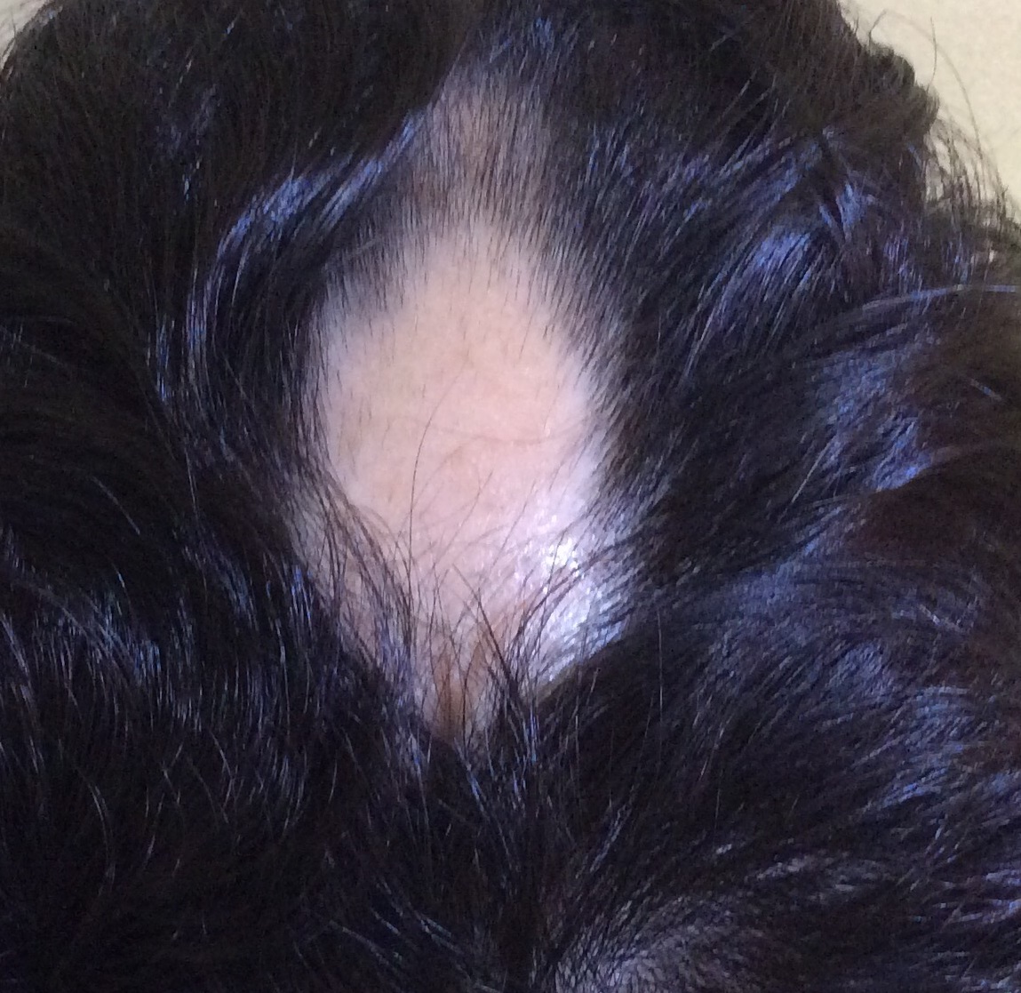 ちょっと意外 円形脱毛症は切れ毛になって広がっていく スーパースカルプ発毛センター