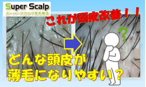 問題です 頭皮をブラシで叩くと髪が生える はウソ ホント どっち スーパースカルプ発毛センター