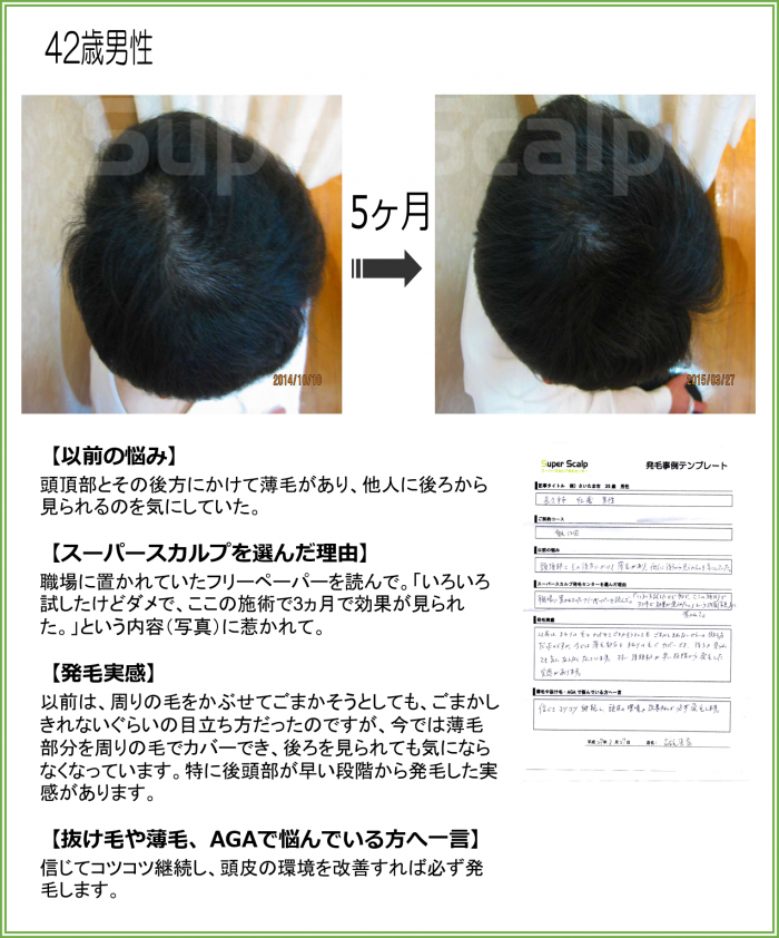 頭頂部 てっぺん ハゲやつむじハゲ 薄毛の原因と対処法は スーパースカルプ発毛センター