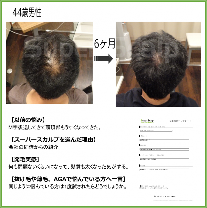 つむじハゲの原因と対策は 施術を行った男性の発毛症例もご紹介 スーパースカルプ発毛センター