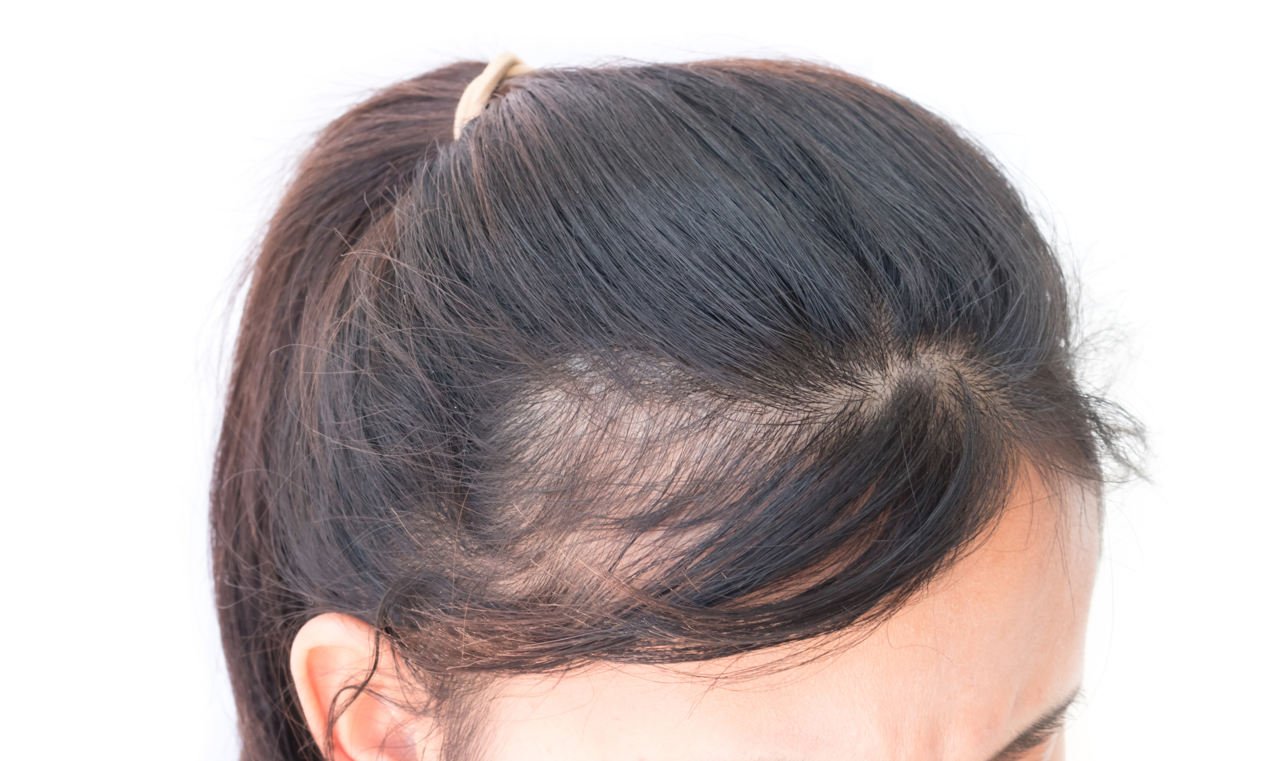 髪を結ぶと薄毛になる 女性に多い耳の上の薄毛の意外な原因 スーパースカルプ発毛センター