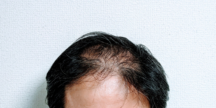 脱毛を引き起こす可能性のある薬