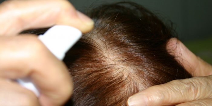 生え際の発毛に育毛剤は効果的？