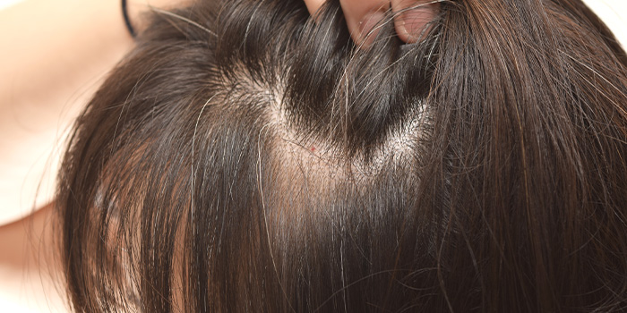 女性の頭皮の接写